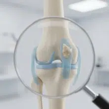 אינפוגרפיקה המסבירה מהם אוסטאופיטים, הידועים גם כזיזי עצם, עם איור להמחשה של בליטת עצם על מפרק.